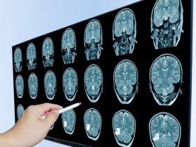 ماده مخفی در غذای و لباس های شما که ظهور زوال عقل را در ایالات متحده توضیح می دهد